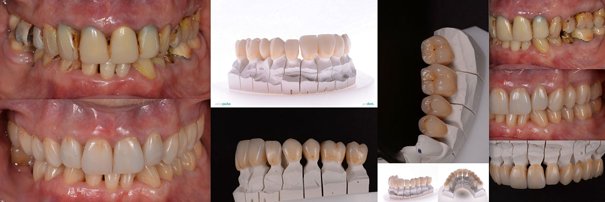 Celková rekonstrukce horní čelisti s ortodontickým předléčením