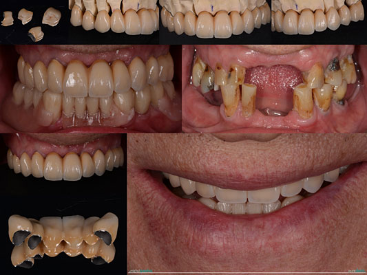 Celková rekonstrukce horní čelisti s ortodontickým předléčením