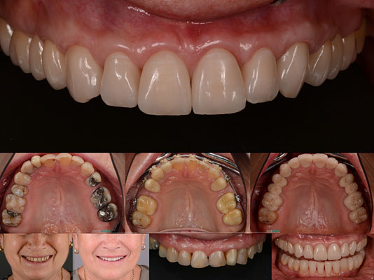 Celková rekonstrukce horní čelisti s ortodontickým předléčením