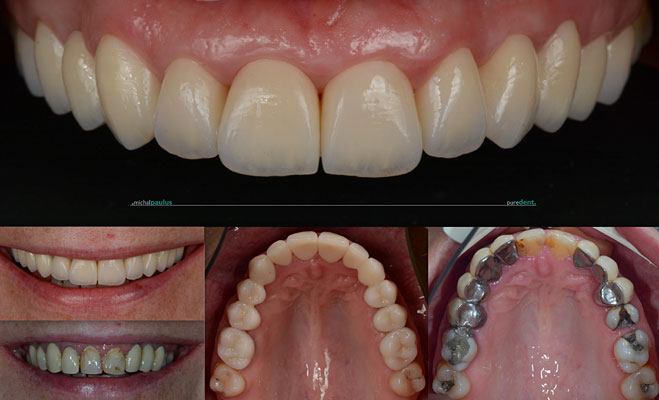 Celková rekonstrukce horní čelisti s ortodontickým předléčením