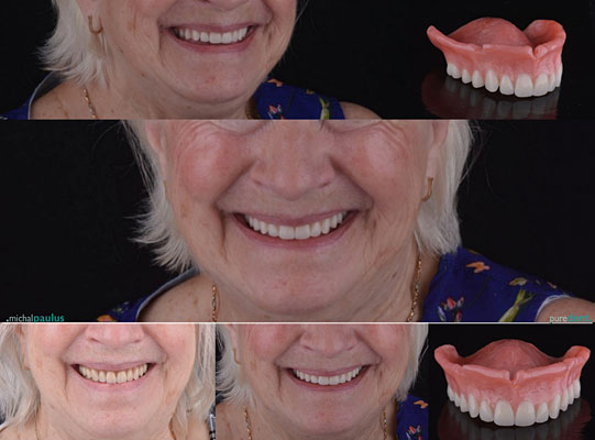 Celková rekonstrukce horní čelisti s ortodontickým předléčením