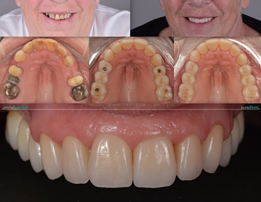 Celková rekonstrukce horní čelisti s ortodontickým předléčením