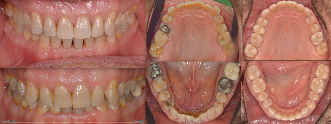 Celková rekonstrukce horní čelisti s ortodontickým předléčením