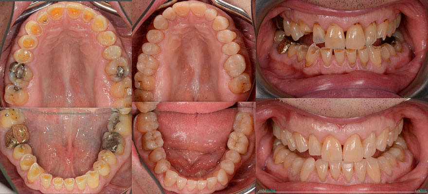 Celková rekonstrukce horní čelisti s ortodontickým předléčením