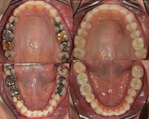 Celková rekonstrukce horní čelisti s ortodontickým předléčením