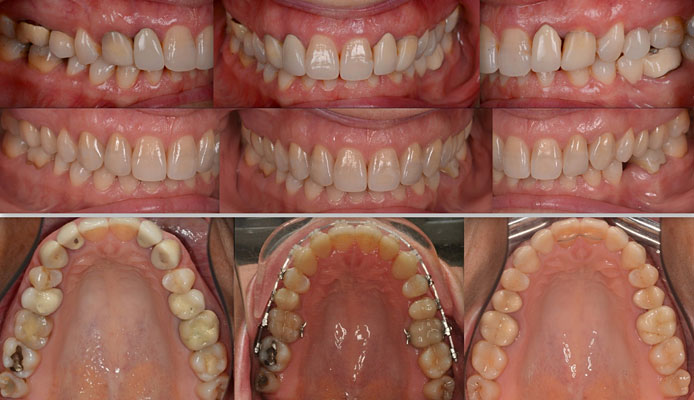 Celková rekonstrukce horní čelisti s ortodontickým předléčením