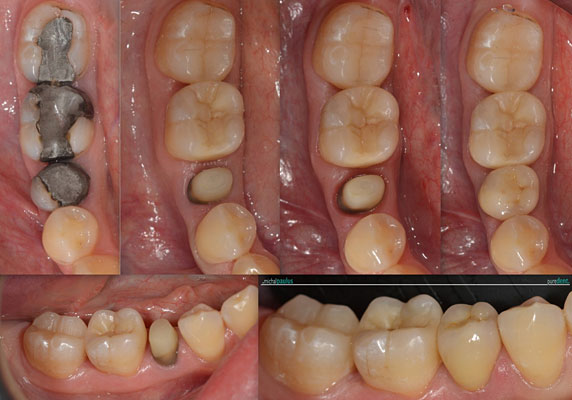 Celková rekonstrukce horní čelisti s ortodontickým předléčením