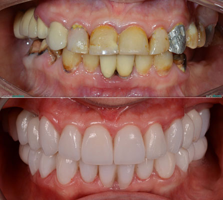 Celková rekonstrukce horní čelisti s ortodontickým předléčením