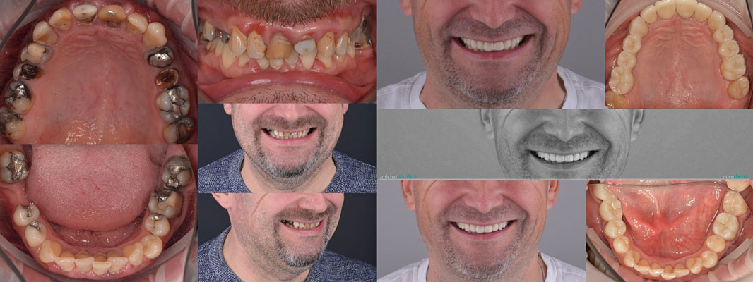 Celková rekonstrukce horní čelisti s ortodontickým předléčením