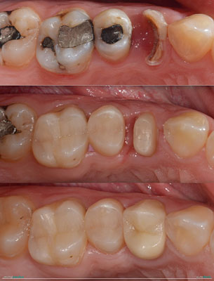 Celková rekonstrukce horní čelisti s ortodontickým předléčením