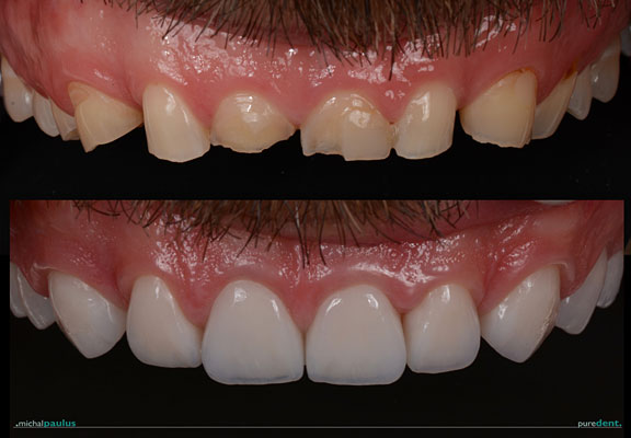 Celková rekonstrukce horní čelisti s ortodontickým předléčením