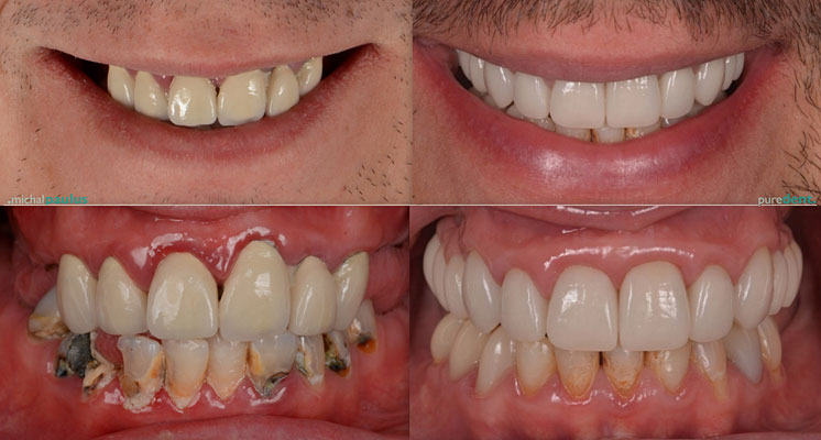 Celková rekonstrukce horní čelisti s ortodontickým předléčením