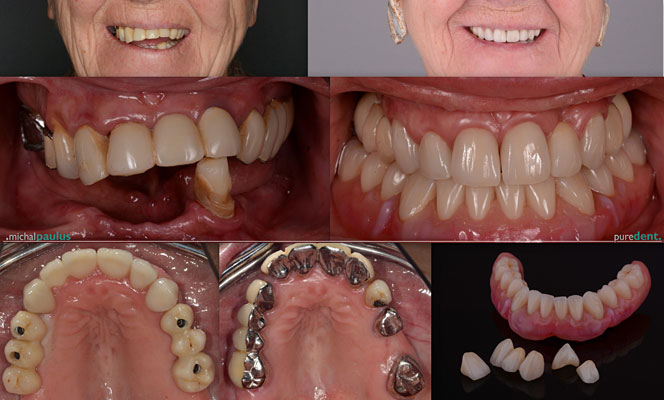 Celková rekonstrukce horní čelisti s ortodontickým předléčením