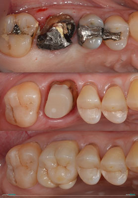 Celková rekonstrukce horní čelisti s ortodontickým předléčením