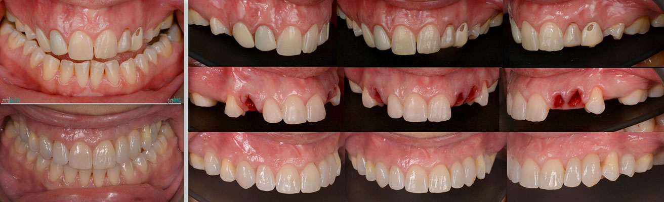 Celková rekonstrukce horní čelisti s ortodontickým předléčením