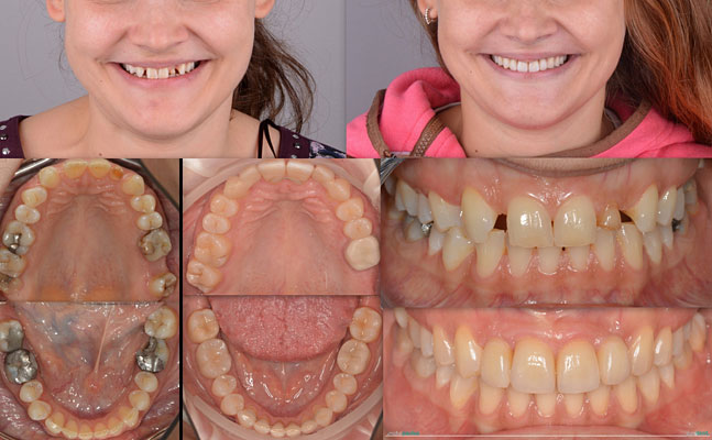 Celková rekonstrukce horní čelisti s ortodontickým předléčením