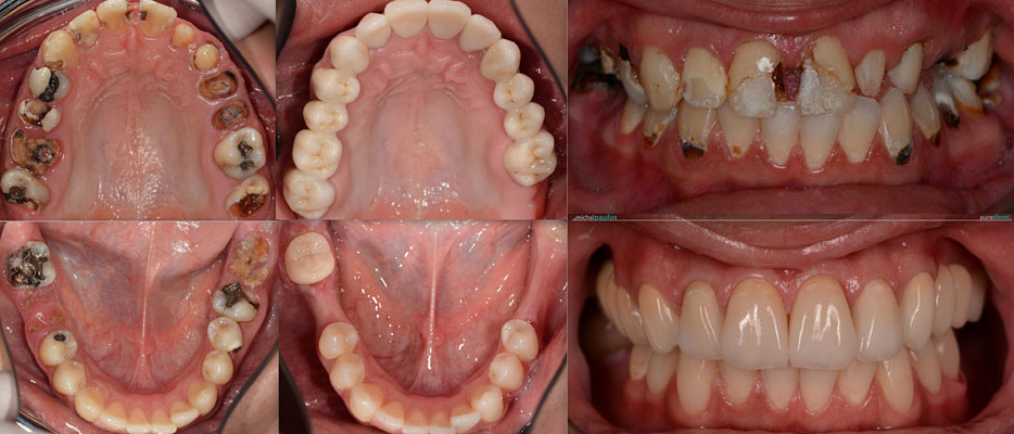 Celková rekonstrukce horní čelisti s ortodontickým předléčením