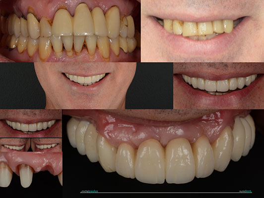 Celková rekonstrukce horní čelisti s ortodontickým předléčením
