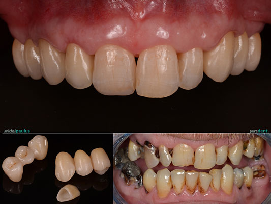 Celková rekonstrukce horní čelisti s ortodontickým předléčením