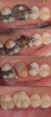 Celková rekonstrukce horní čelisti s ortodontickým předléčením