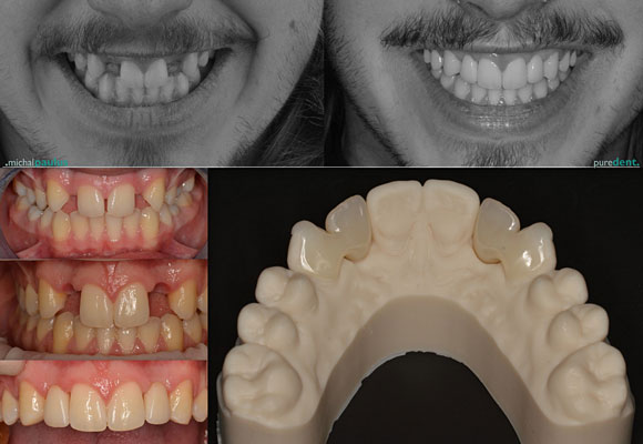 Celková rekonstrukce horní čelisti s ortodontickým předléčením