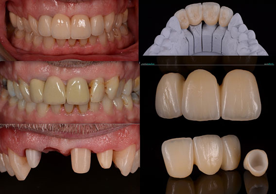 Celková rekonstrukce horní čelisti s ortodontickým předléčením