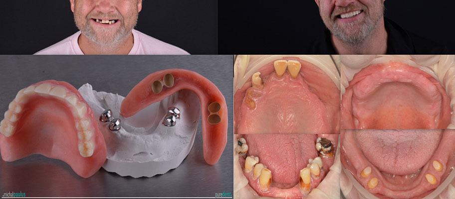 Celková rekonstrukce horní čelisti s ortodontickým předléčením